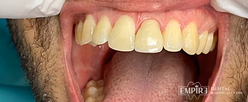 After dental treatment result at Empire Dental Clinic Dublin 1 — case 1