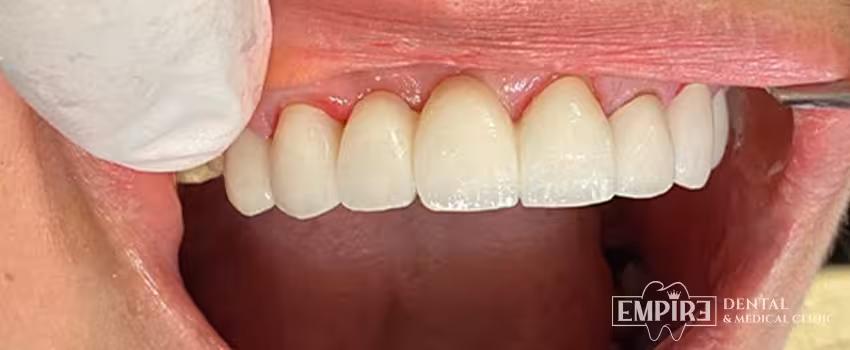 After dental treatment result at Empire Dental Clinic Dublin 1 — case 2