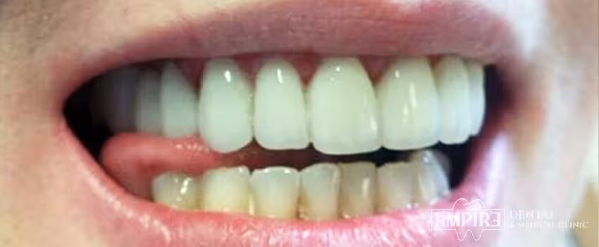 After dental treatment result at Empire Dental Clinic Dublin 1 — case 3