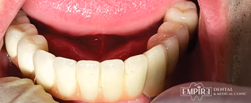 After dental treatment result at Empire Dental Clinic Dublin 1 — case 4