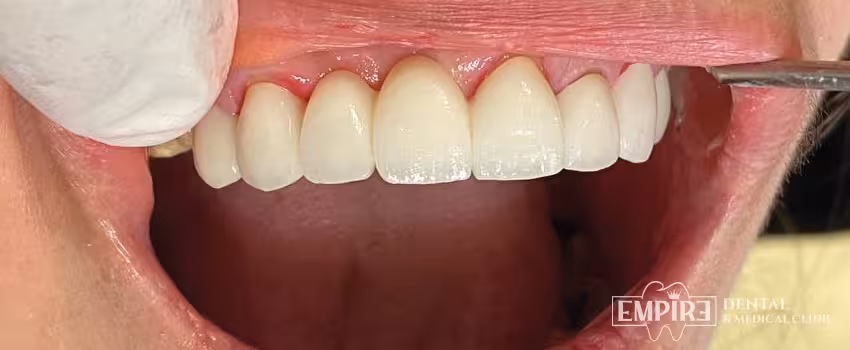 After dental treatment result at Empire Dental Clinic Dublin 1 — case 9