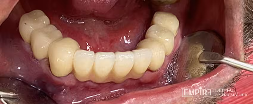 After dental treatment result at Empire Dental Clinic Dublin 1 — case 6