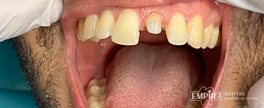 Before dental treatment at Empire Dental Clinic Dublin 1 — case 1