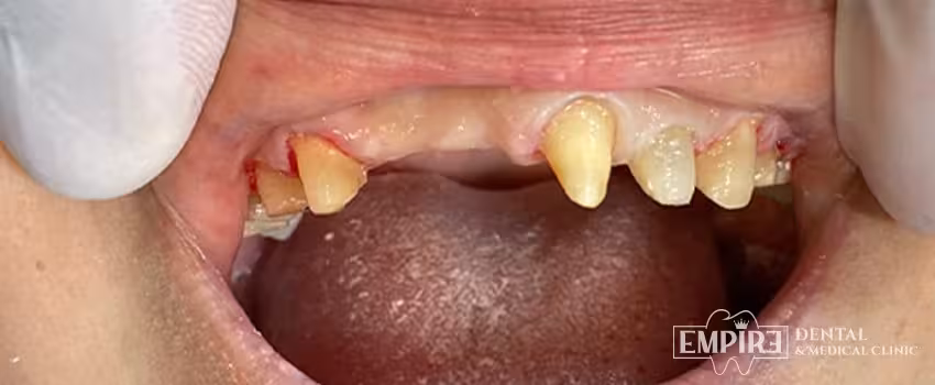 Before dental treatment at Empire Dental Clinic Dublin 1 — case 2