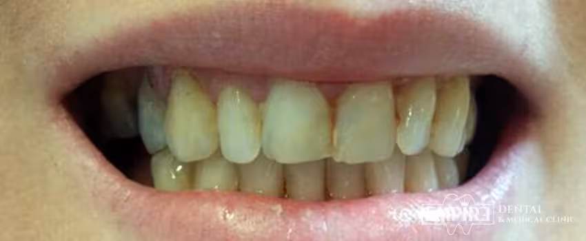Before dental treatment at Empire Dental Clinic Dublin 1 — case 3