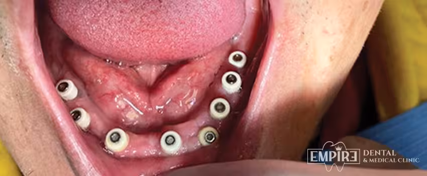Before dental treatment at Empire Dental Clinic Dublin 1 — case 4