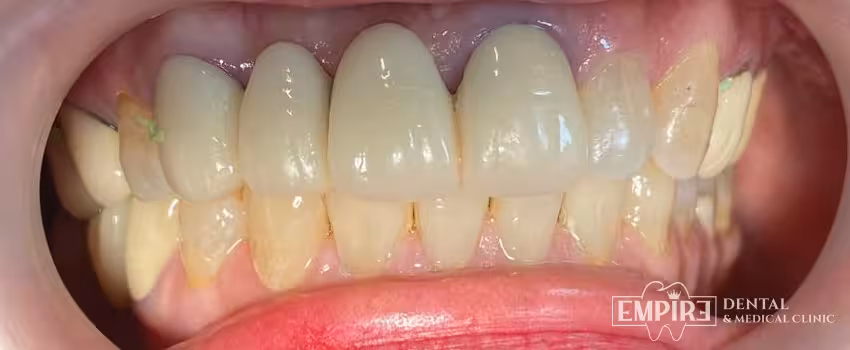 Before dental treatment at Empire Dental Clinic Dublin 1 — case 9