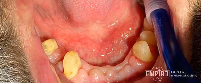 Before dental treatment at Empire Dental Clinic Dublin 1 — case 6