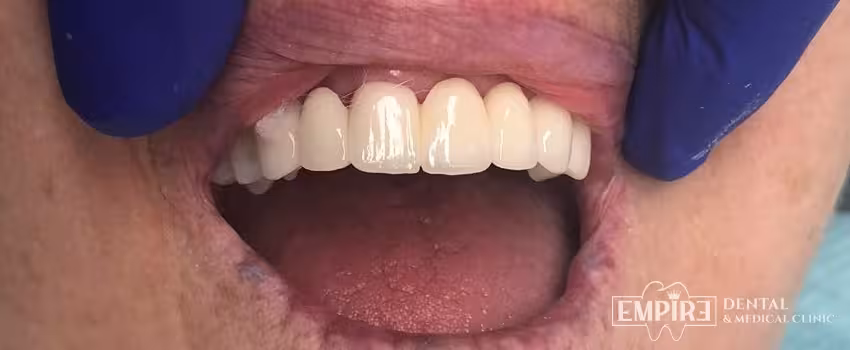 After dental treatment result at Empire Dental Clinic Dublin 1 — case 10