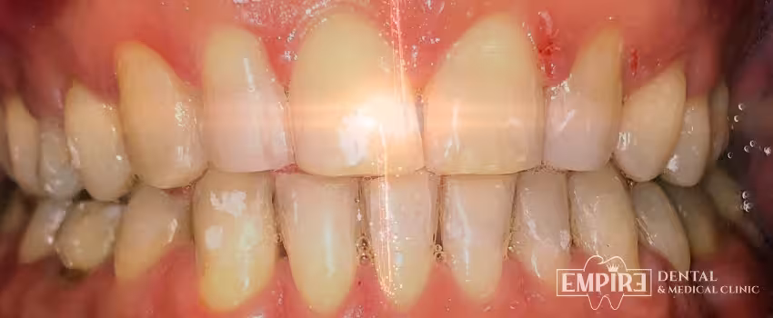 After dental treatment result at Empire Dental Clinic Dublin 1 — case 11