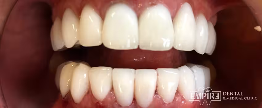 After dental treatment result at Empire Dental Clinic Dublin 1 — case 12