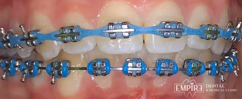 After dental treatment result at Empire Dental Clinic Dublin 1 — case 13