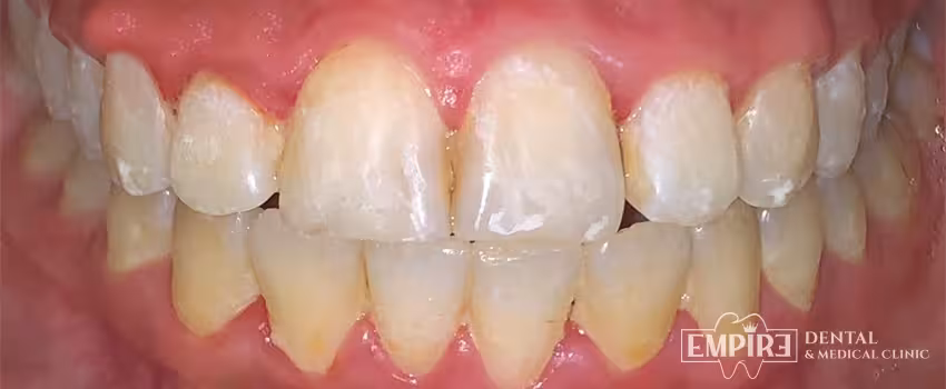 After dental treatment result at Empire Dental Clinic Dublin 1 — case 14