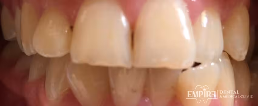 Before dental treatment at Empire Dental Clinic Dublin 1 — case 14