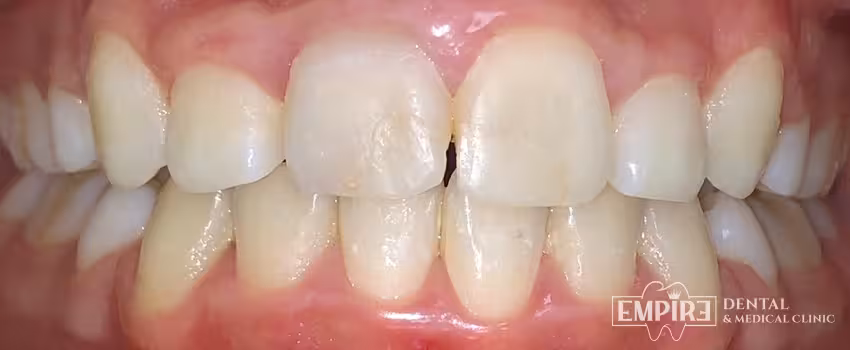 After dental treatment result at Empire Dental Clinic Dublin 1 — case 15