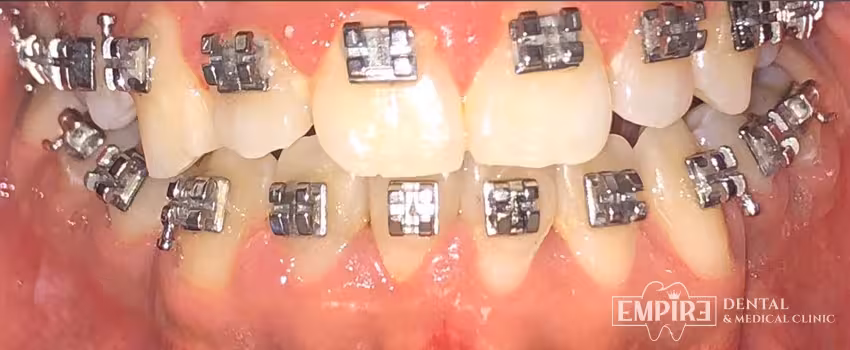 After dental treatment result at Empire Dental Clinic Dublin 1 — case 19