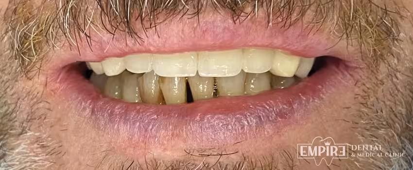 After dental treatment result at Empire Dental Clinic Dublin 1 — case 17