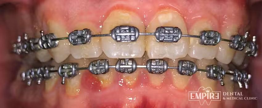 After dental treatment result at Empire Dental Clinic Dublin 1 — case 18