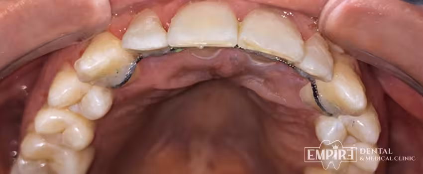After dental treatment result at Empire Dental Clinic Dublin 1 — case 20