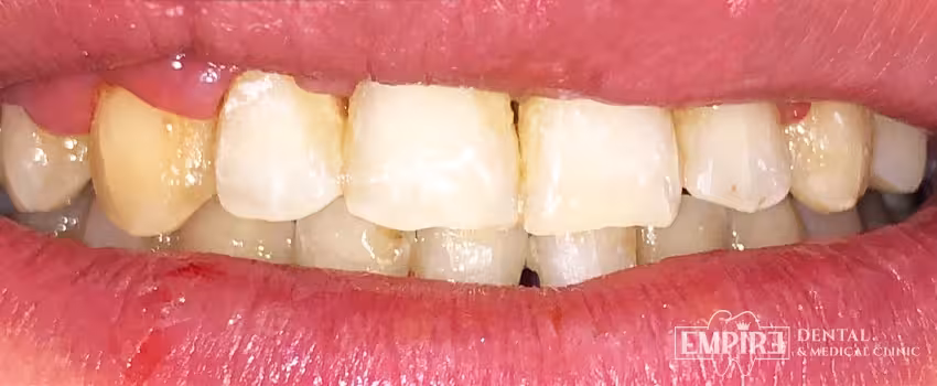 After dental treatment result at Empire Dental Clinic Dublin 1 — case 7