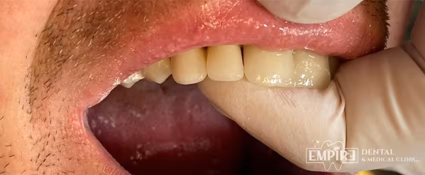 After dental treatment result at Empire Dental Clinic Dublin 1 — case 8