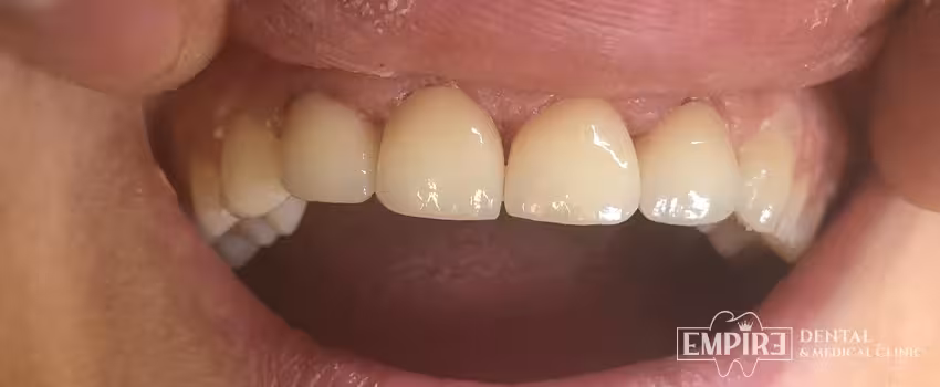 After dental treatment result at Empire Dental Clinic Dublin 1 — case 5