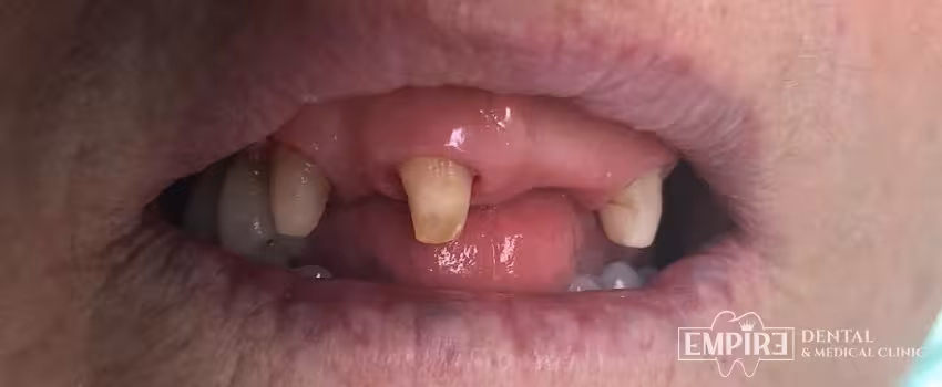 Before dental treatment at Empire Dental Clinic Dublin 1 — case 10