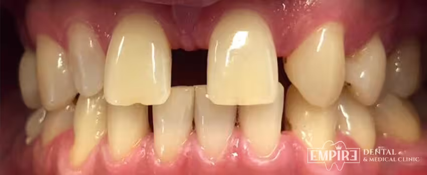 Before dental treatment at Empire Dental Clinic Dublin 1 — case 11