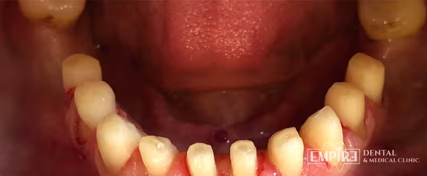 Before dental treatment at Empire Dental Clinic Dublin 1 — case 12