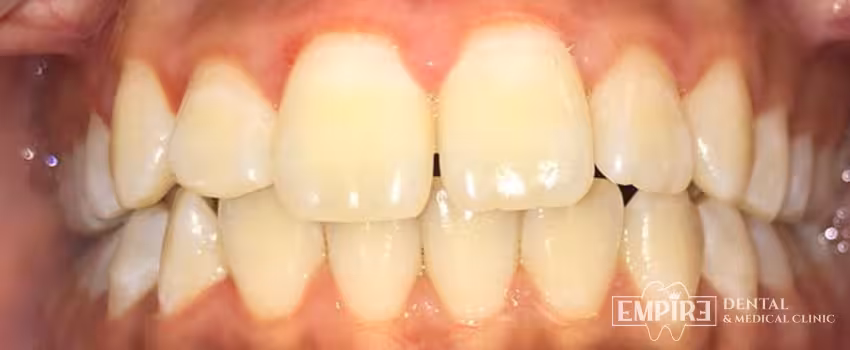 Before dental treatment at Empire Dental Clinic Dublin 1 — case 13