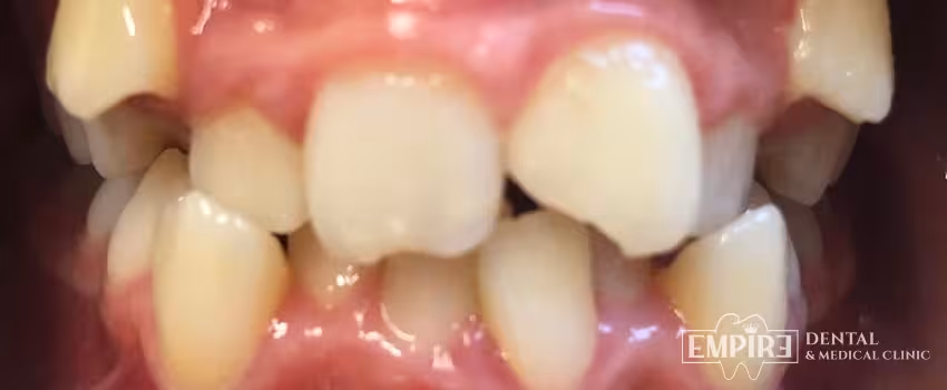 Before dental treatment at Empire Dental Clinic Dublin 1 — case 15