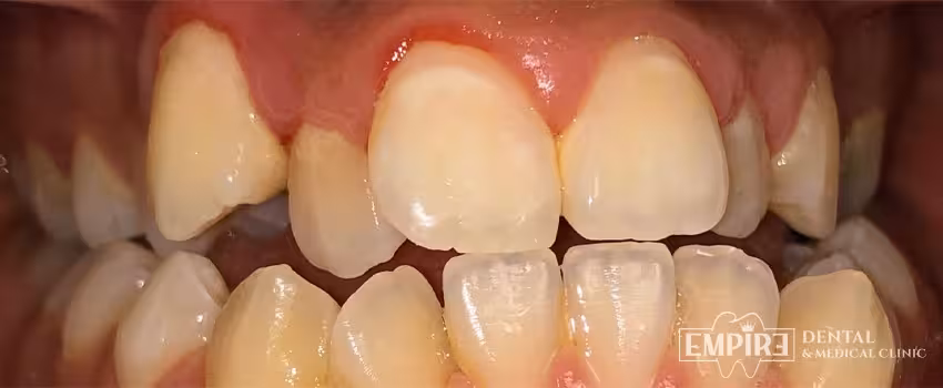Before dental treatment at Empire Dental Clinic Dublin 1 — case 19