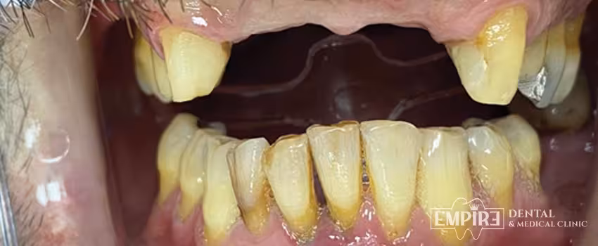 Before dental treatment at Empire Dental Clinic Dublin 1 — case 17