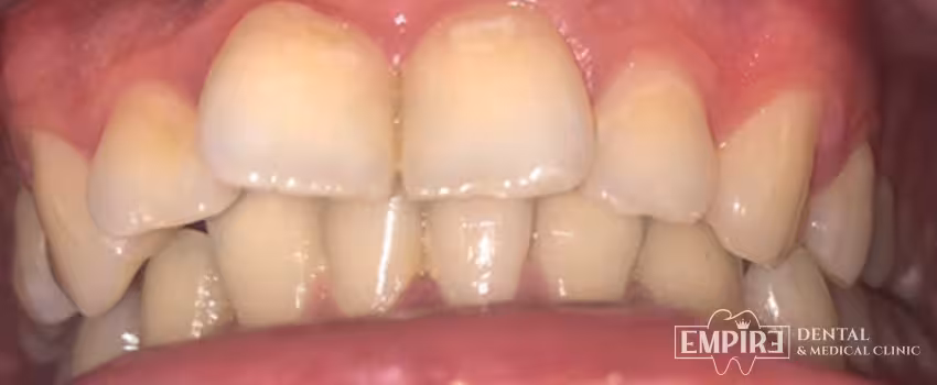 Before dental treatment at Empire Dental Clinic Dublin 1 — case 18