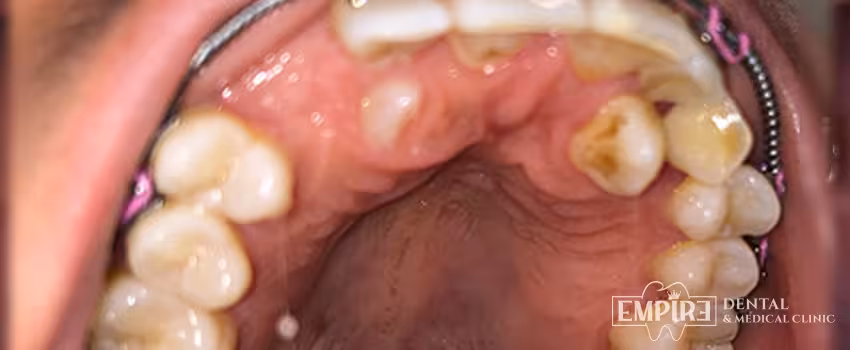 Before dental treatment at Empire Dental Clinic Dublin 1 — case 20