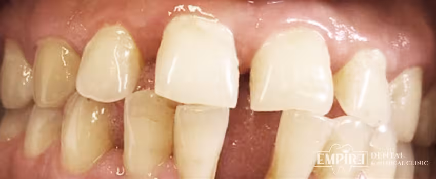 Before dental treatment at Empire Dental Clinic Dublin 1 — case 7
