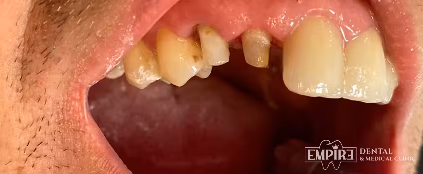 Before dental treatment at Empire Dental Clinic Dublin 1 — case 8