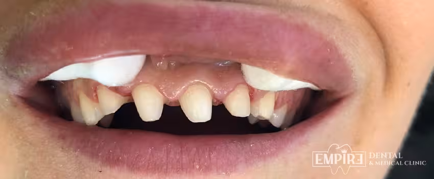 Before dental treatment at Empire Dental Clinic Dublin 1 — case 5