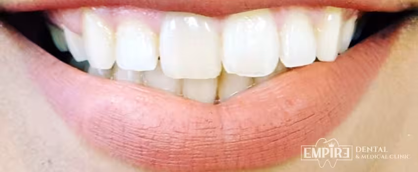 After non-surgical facial aesthetics result at Empire Clinic Dublin 1 — case 1