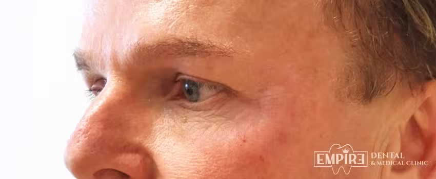 After non-surgical facial aesthetics result at Empire Clinic Dublin 1 — case 3