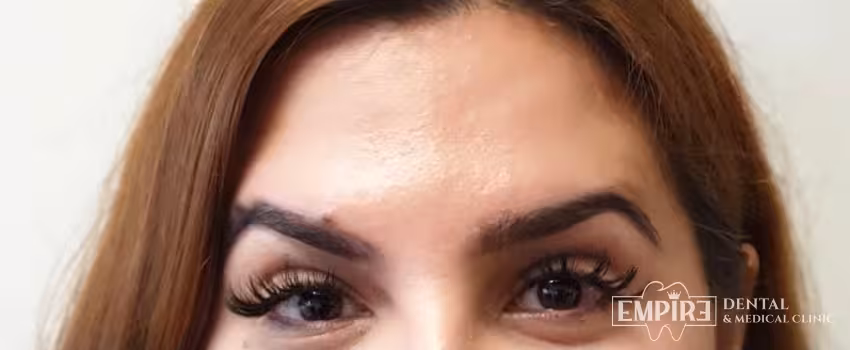 After non-surgical facial aesthetics result at Empire Clinic Dublin 1 — case 11