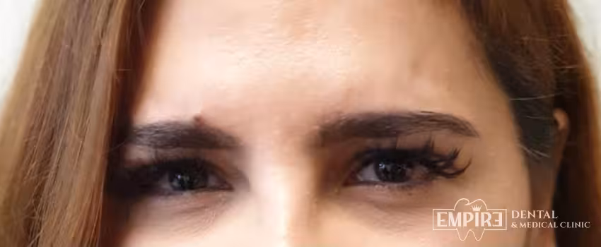 After non-surgical facial aesthetics result at Empire Clinic Dublin 1 — case 4