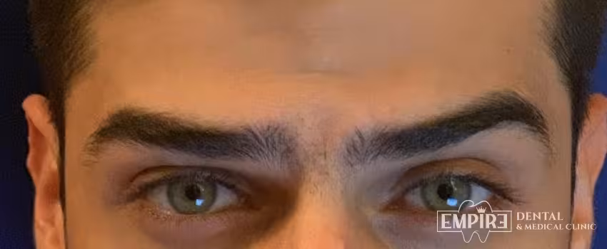 After non-surgical facial aesthetics result at Empire Clinic Dublin 1 — case 6