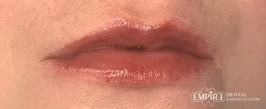After non-surgical facial aesthetics result at Empire Clinic Dublin 1 — case 7