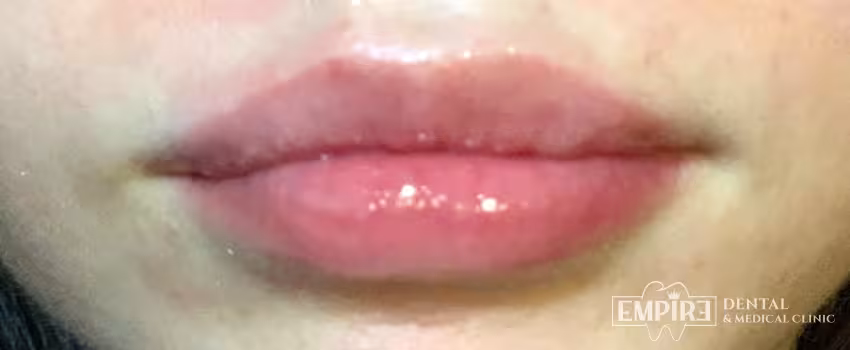 After non-surgical facial aesthetics result at Empire Clinic Dublin 1 — case 8