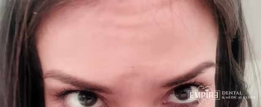After non-surgical facial aesthetics result at Empire Clinic Dublin 1 — case 9