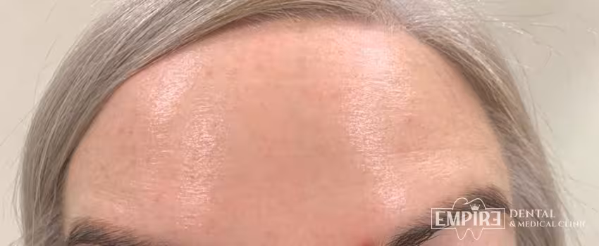 After non-surgical facial aesthetics result at Empire Clinic Dublin 1 — case 10