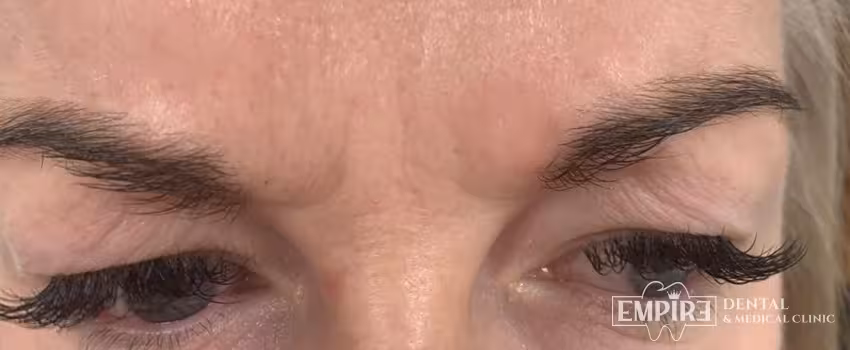 After non-surgical facial aesthetics result at Empire Clinic Dublin 1 — case 12