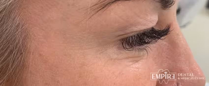 After non-surgical facial aesthetics result at Empire Clinic Dublin 1 — case 5