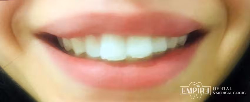 After non-surgical facial aesthetics result at Empire Clinic Dublin 1 — case 13
